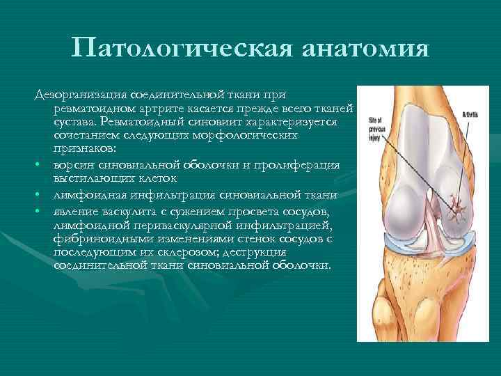  Патологическая анатомия Дезорганизация соединительной ткани при  ревматоидном артрите касается прежде всего тканей