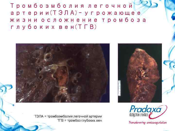 Тромбоэмболия легочной артерии(ТЭЛА) – угрожающее жизни осложнение тромбоза глубоких вен(ТГВ)   ТЭЛА =