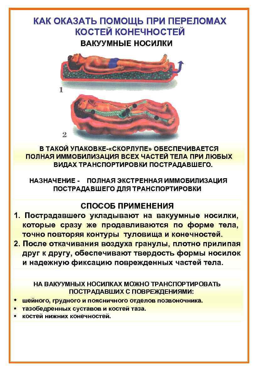 КАК ОКАЗАТЬ ПОМОЩЬ ПРИ ПЕРЕЛОМАХ КОСТЕЙ КОНЕЧНОСТЕЙ ВАКУУМНЫЕ НОСИЛКИ КАК ОКАЗАТЬ ПОМОЩЬ ПРИ ПЕРЕЛОМАХ КОСТЕЙ КОНЕЧНОСТЕЙ ВАКУУМНЫЕ НОСИЛКИ
