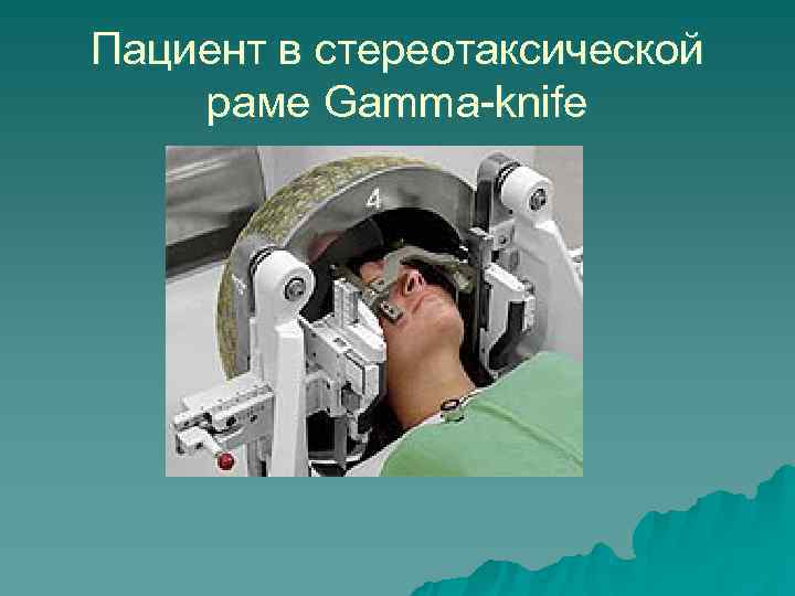 Пациент в стереотаксической раме Gamma-knife 