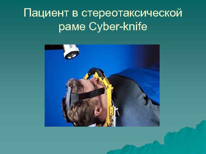 Пациент в стереотаксической раме Cyber-knife 