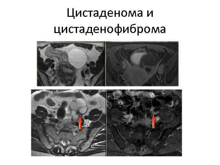  Цистаденома и цистаденофиброма 