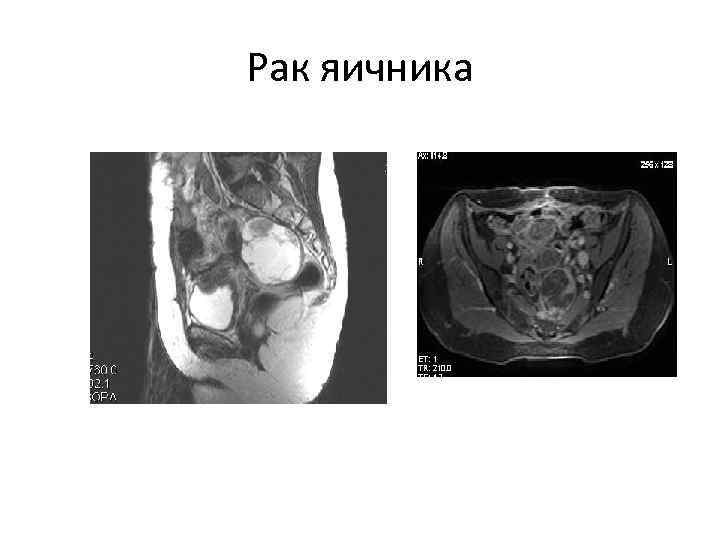 Рак яичника 