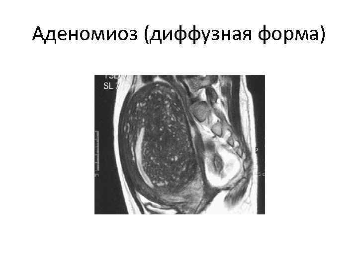 Аденомиоз (диффузная форма) 
