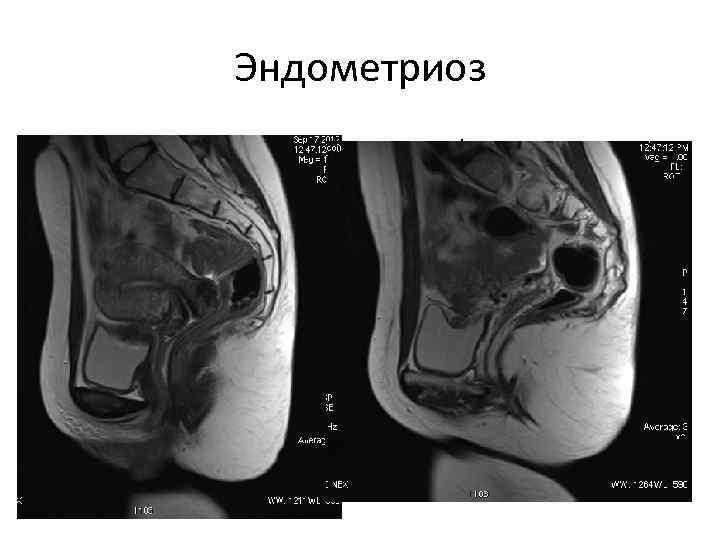 Мрт малого таза у женщин