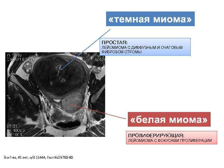     «темная миома»     ПРОСТАЯ:  