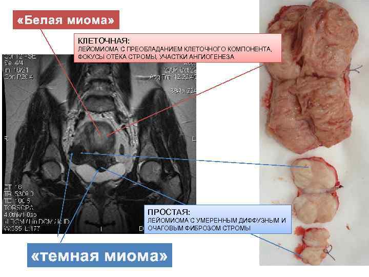  «Белая миома»   КЛЕТОЧНАЯ:  ЛЕЙОМИОМА С ПРЕОБЛАДАНИЕМ КЛЕТОЧНОГО КОМПОНЕНТА,  ФОКУСЫ