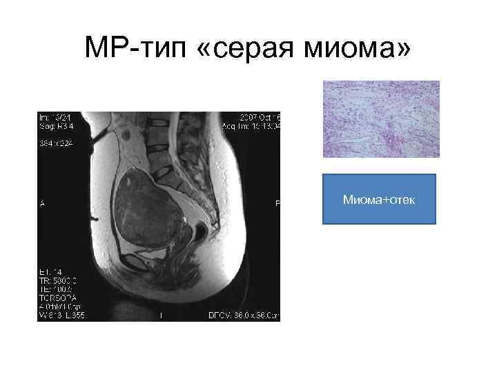 МР-тип «серая миома»    Миома+отек 