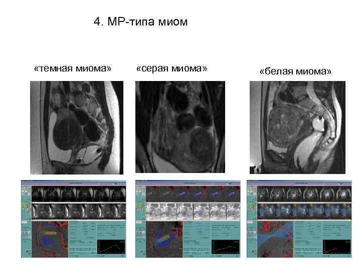   4. МР-типа миом  «темная миома» «серая миома» «белая миома» 