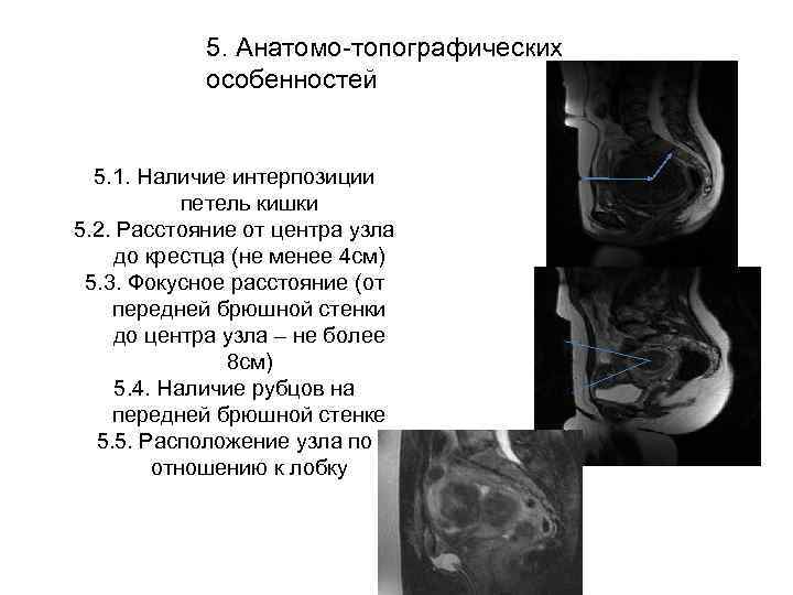   5. Анатомо-топографических   особенностей 5. 1. Наличие интерпозиции   петель