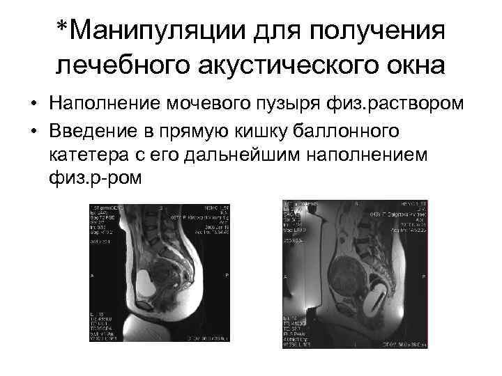  *Манипуляции для получения  лечебного акустического окна • Наполнение мочевого пузыря физ. раствором
