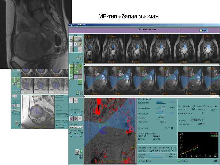 МР-тип «белая миома» 