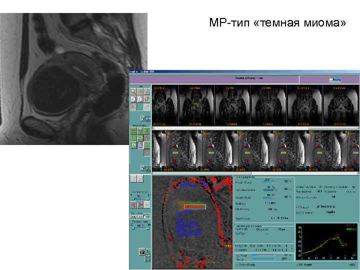 МР-тип «темная миома» 