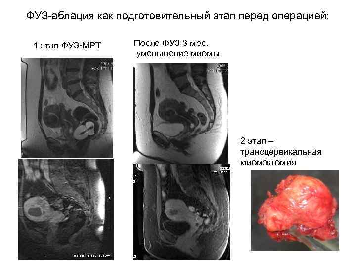 ФУЗ-аблация как подготовительный этап перед операцией: 1 этап ФУЗ-МРТ  После ФУЗ 3 мес.