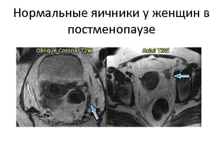 Нормальные яичники у женщин в  постменопаузе 