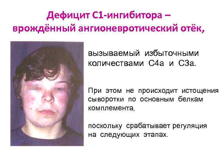  Дефицит С 1 -ингибитора – врождённый ангионевротический отёк,    вызываемый избыточными