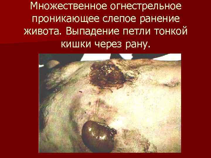 Множественное огнестрельное проникающее слепое ранение живота. Выпадение петли тонкой кишки через рану. Множественное огнестрельное проникающее слепое ранение живота. Выпадение петли тонкой кишки через рану.