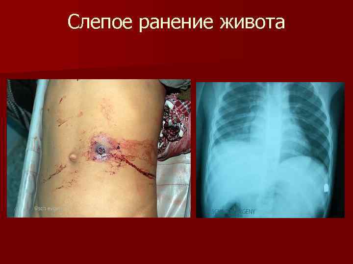 Слепое ранение живота Слепое ранение живота