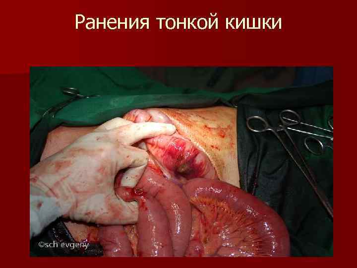 Ранения тонкой кишки Ранения тонкой кишки