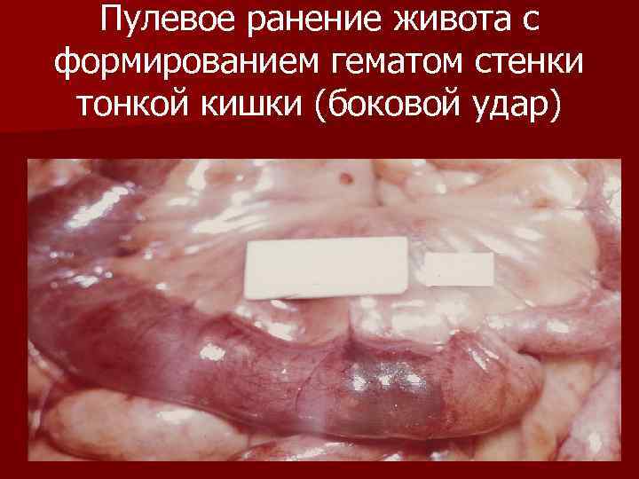 Пулевое ранение живота с формированием гематом стенки тонкой кишки (боковой удар) Пулевое ранение живота с формированием гематом стенки тонкой кишки (боковой удар)