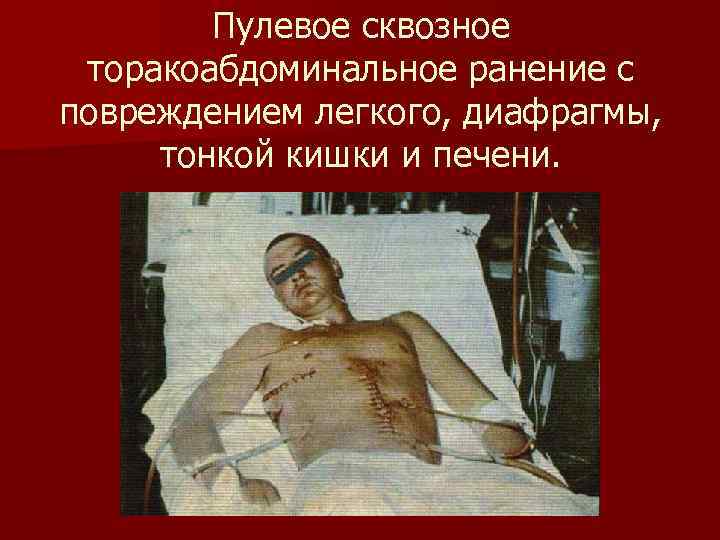 Пулевое сквозное торакоабдоминальное ранение с повреждением легкого, диафрагмы, тонкой кишки и Пулевое сквозное торакоабдоминальное ранение с повреждением легкого, диафрагмы, тонкой кишки и