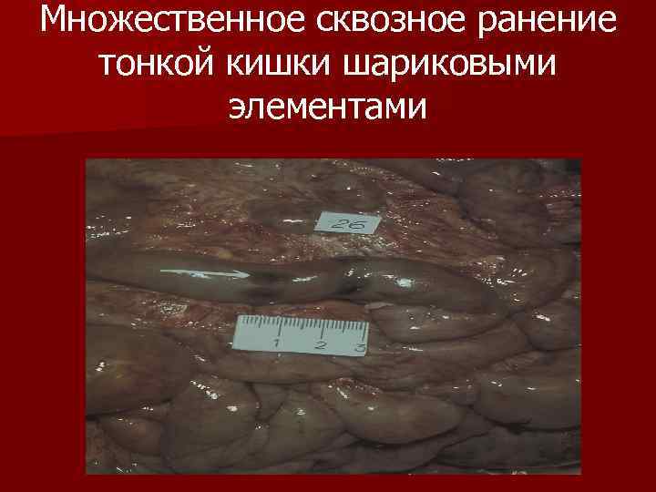 Множественное сквозное ранение тонкой кишки шариковыми элементами Множественное сквозное ранение тонкой кишки шариковыми элементами