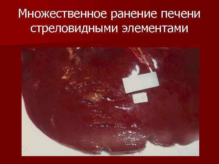 Множественное ранение печени стреловидными элементами Множественное ранение печени стреловидными элементами