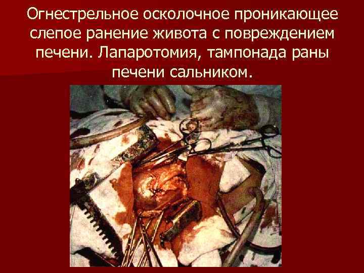 Огнестрельное осколочное проникающее слепое ранение живота с повреждением печени. Лапаротомия, тампонада раны печени Огнестрельное осколочное проникающее слепое ранение живота с повреждением печени. Лапаротомия, тампонада раны печени