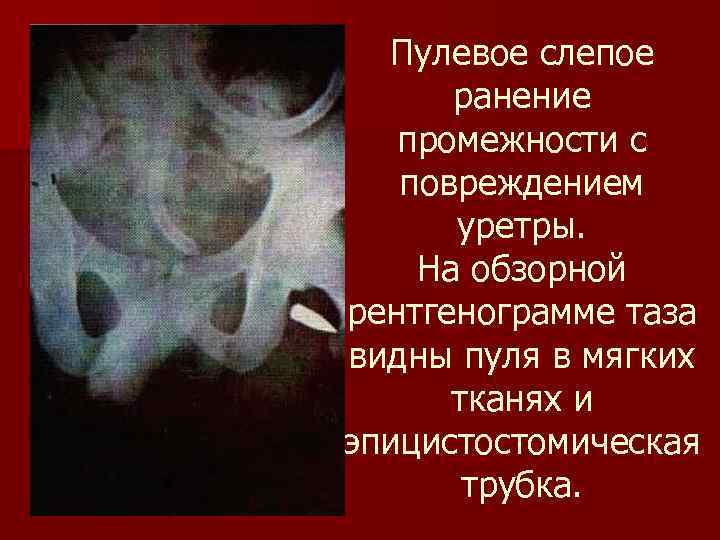 Слепое ранение что это