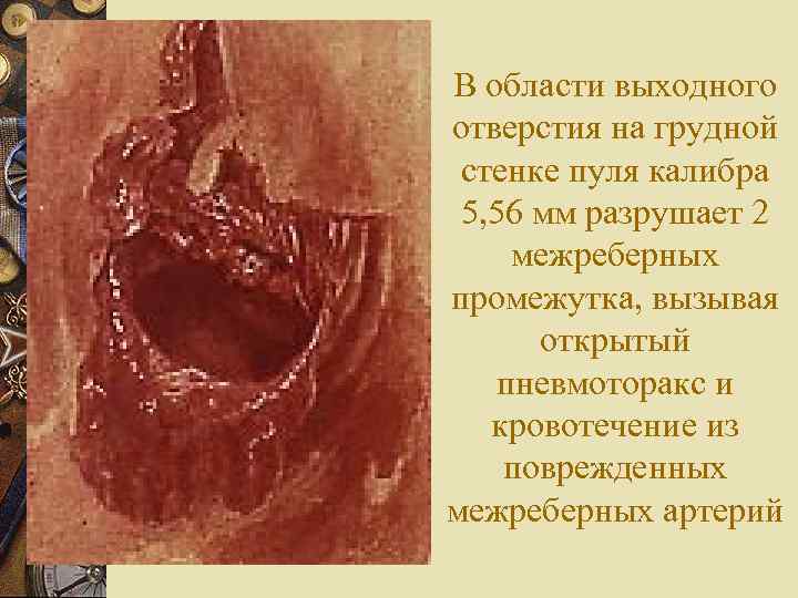 В области выходного отверстия на грудной стенке пуля калибра 5, 56 мм разрушает 2