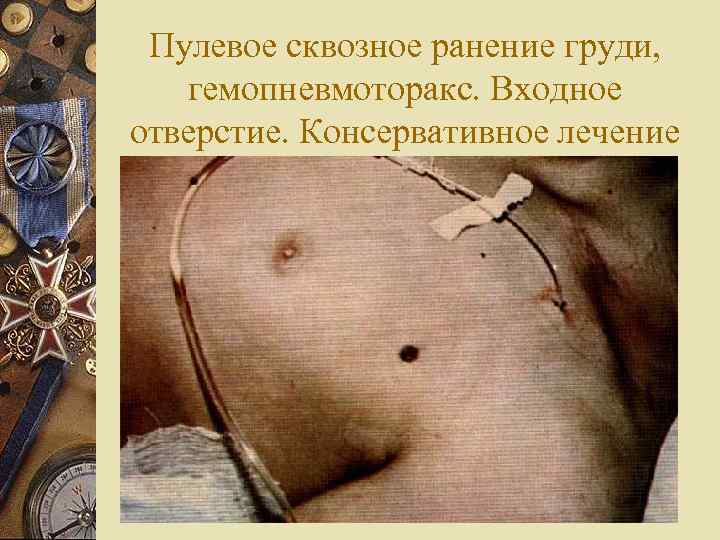  Пулевое сквозное ранение груди, гемопневмоторакс. Входное отверстие. Консервативное лечение 