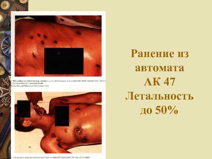  Ранение из  автомата АК 47 Летальность  до 50% 