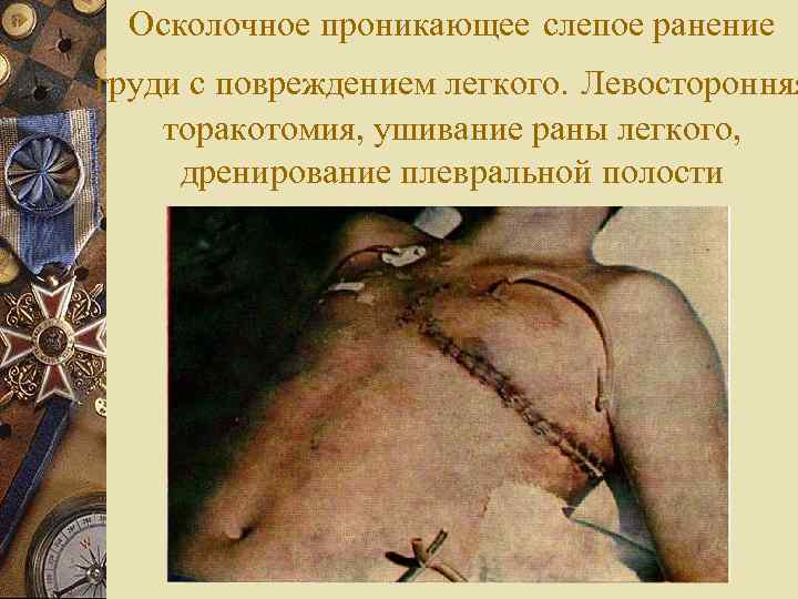  Осколочное проникающее слепое ранение груди с повреждением легкого. Левосторонняя торакотомия, ушивание раны легкого,