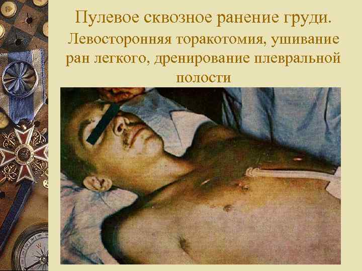  Пулевое сквозное ранение груди. Левосторонняя торакотомия, ушивание ран легкого, дренирование плевральной  