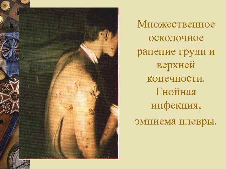 Множественное  осколочное ранение груди и верхней  конечности. Гнойная  инфекция, эмпиема плевры.