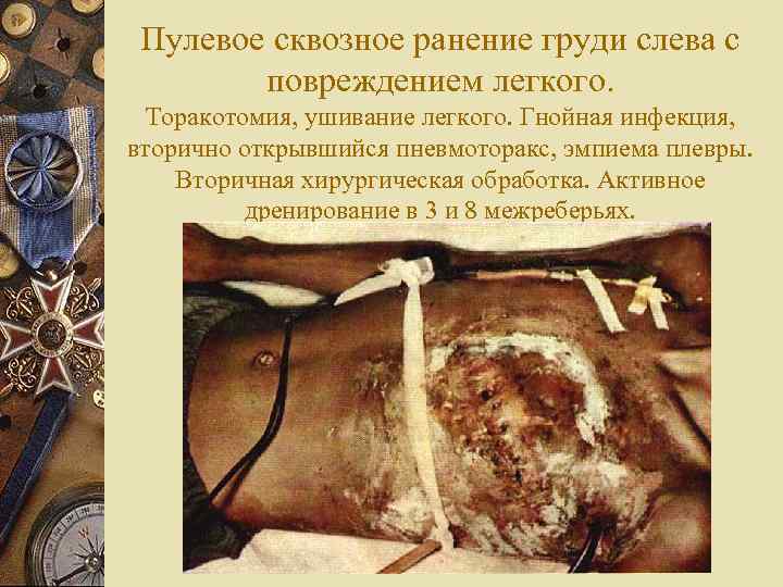  Пулевое сквозное ранение груди слева с   повреждением легкого.  Торакотомия, ушивание