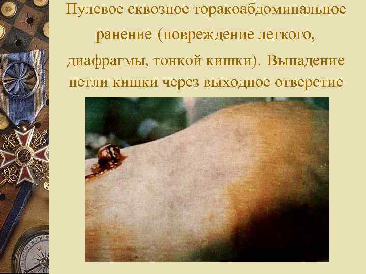 Пулевое сквозное торакоабдоминальное  ранение (повреждение легкого, диафрагмы, тонкой кишки). Выпадение петли кишки через