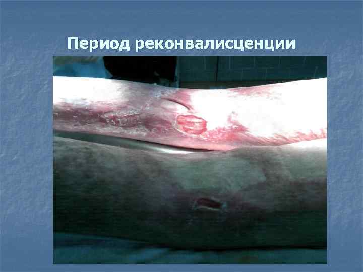 Период реконвалисценции 