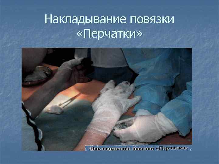 Накладывание повязки  «Перчатки» 