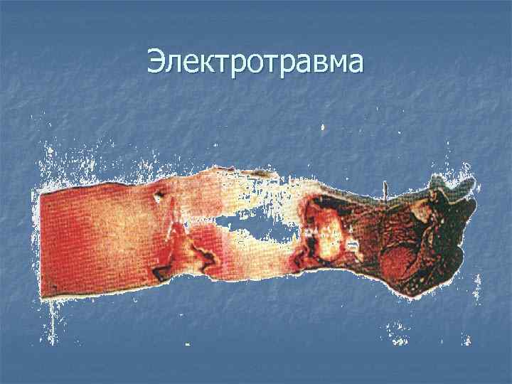 Электротравма 