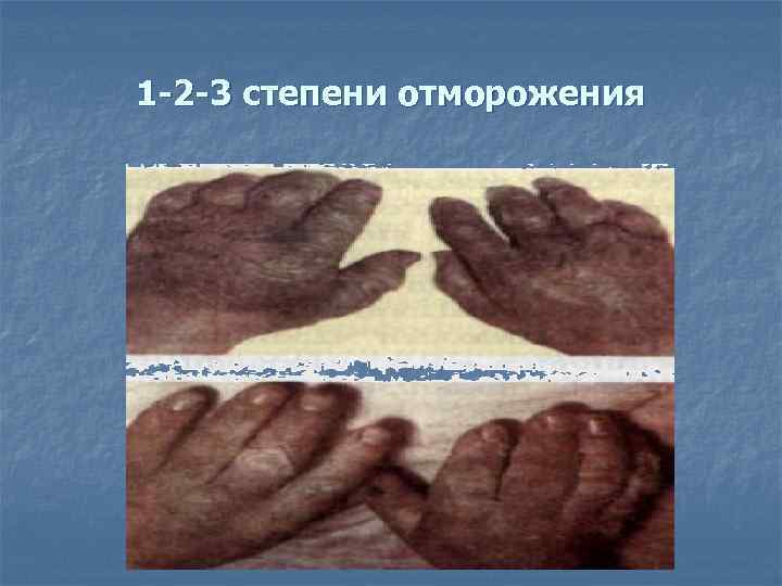 1 -2 -3 степени отморожения 