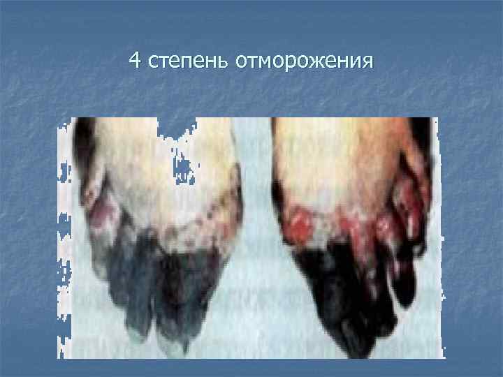 4 степень отморожения 