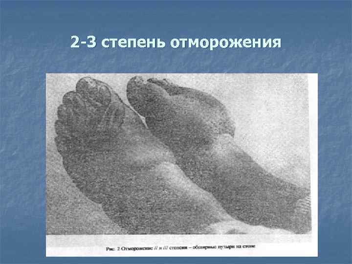 2 -3 степень отморожения 