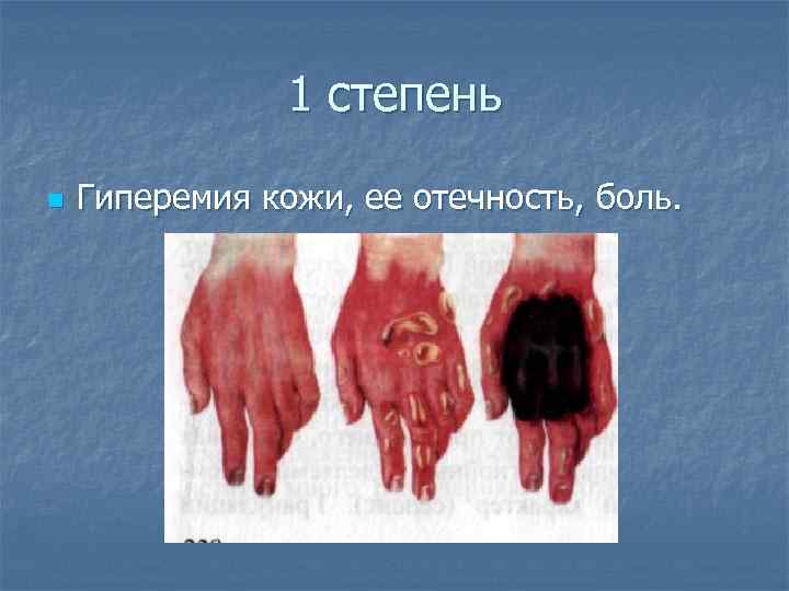     1 степень n  Гиперемия кожи, ее отечность, боль. 