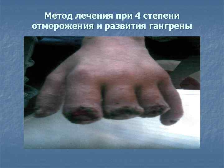  Метод лечения при 4 степени отморожения и развития гангрены 