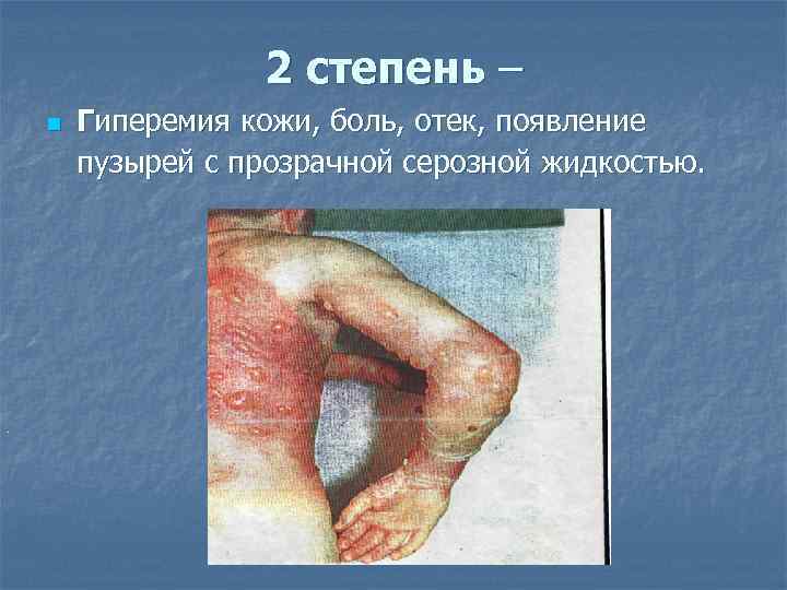     2 степень – n  Гиперемия кожи, боль, отек, появление