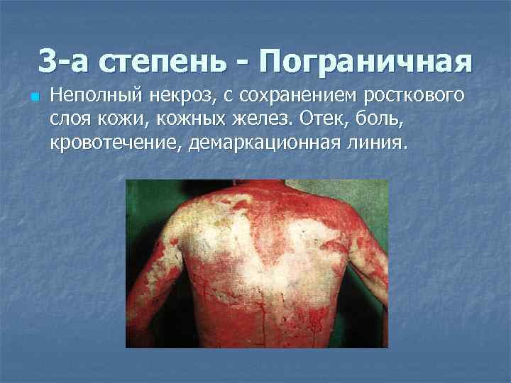 3 -а степень - Пограничная n  Неполный некроз, с сохранением росткового слоя кожи,