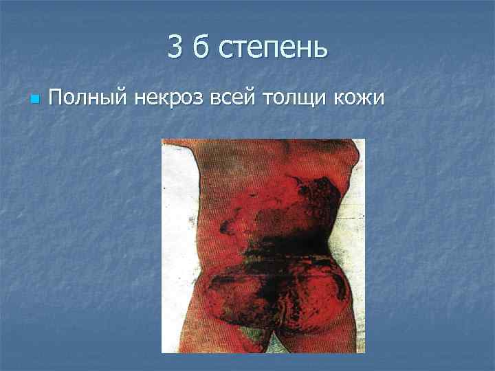    3 б степень n  Полный некроз всей толщи кожи 