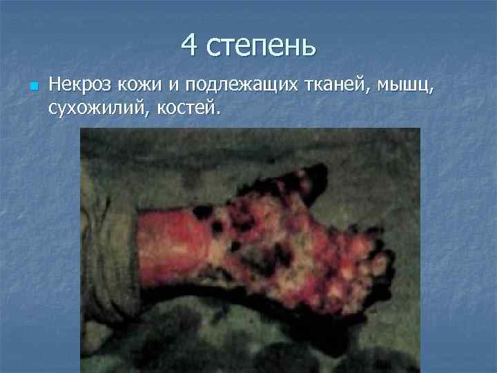     4 степень n  Некроз кожи и подлежащих тканей, мышц,