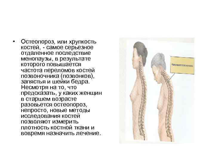 • Остеопороз, или хрупкость костей, самое серьезное отдаленное последствие • Остеопороз, или хрупкость костей, самое серьезное отдаленное последствие